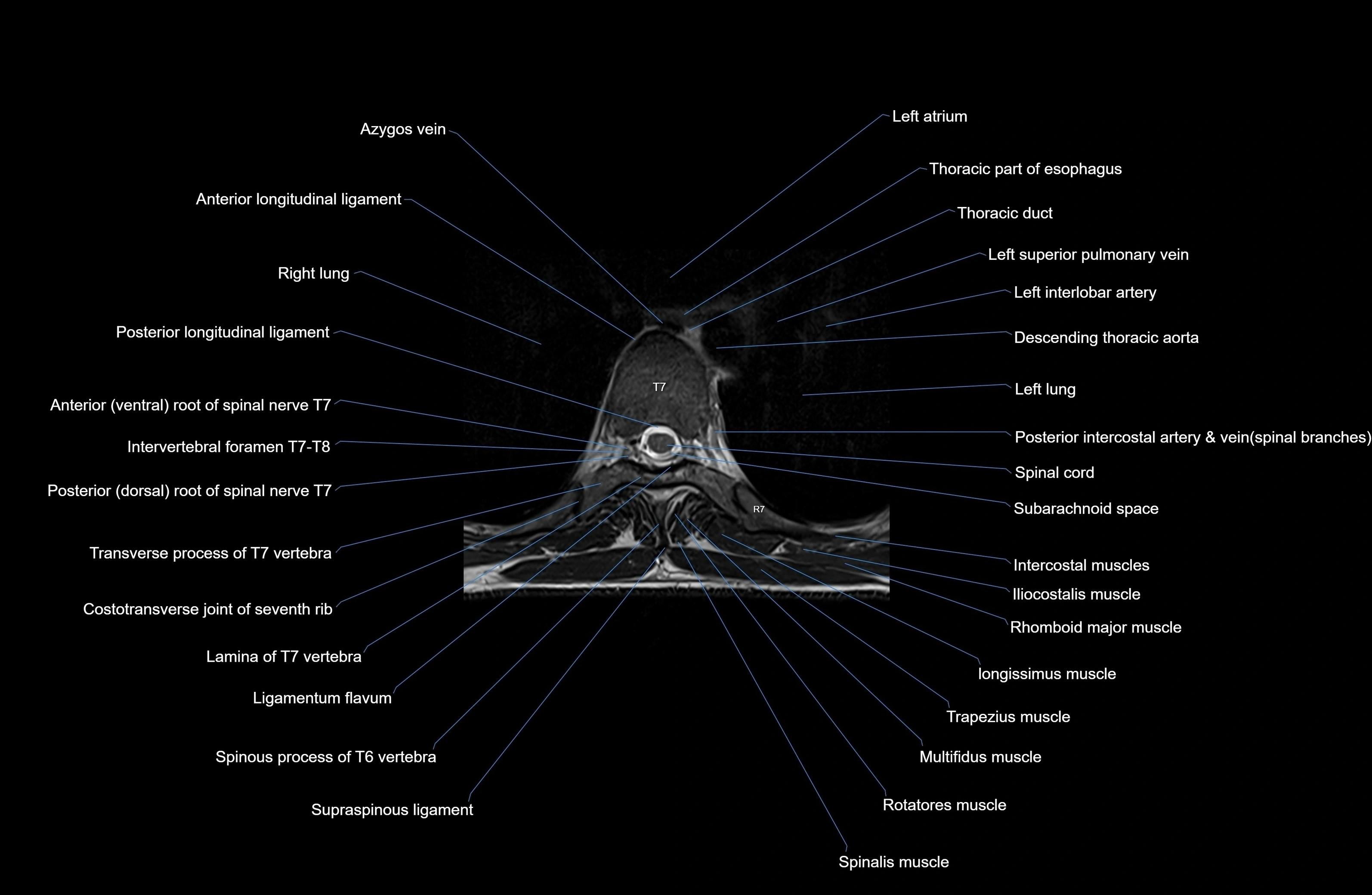 MRI thoracic spine axial  cross sectional anatomy 3T radiology  image-img-00001-00046.webp